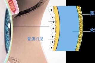 给您说说藏于眼睑内部的腺体——睑板腺